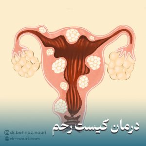 درمان کیست رحم