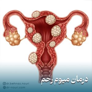 درمان میوم رحم