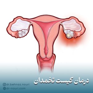درمان کیست تخمدان