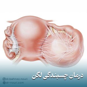 درمان چسبندگی لگن