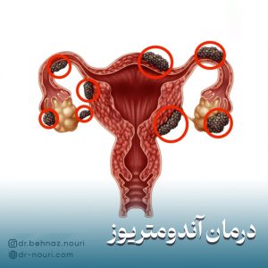 درمان آندومتریوز