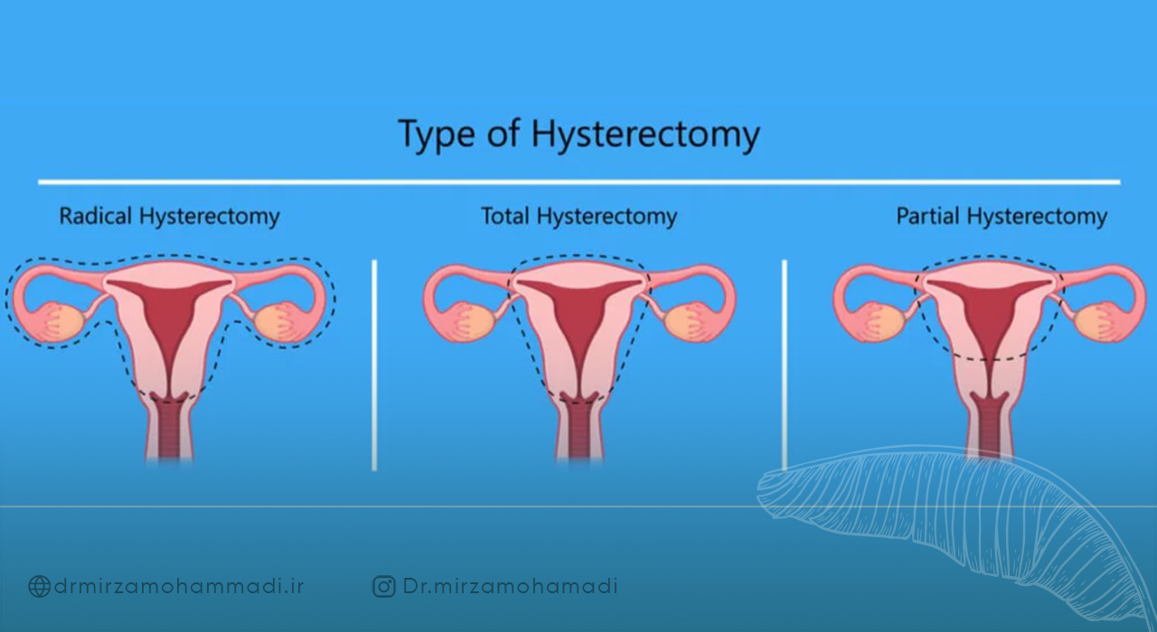 دلایل انجام هیسترکتومی