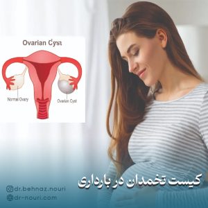 درمان کیست تخمدان در بارداری